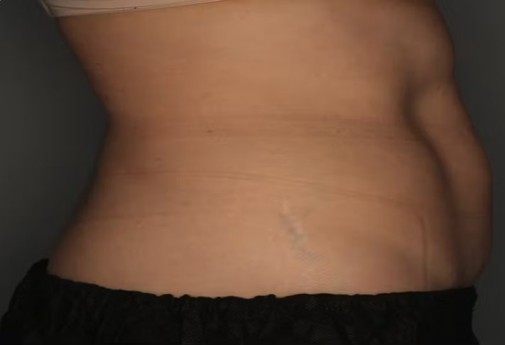 CoolSculpting® After, Female 41 - 4034