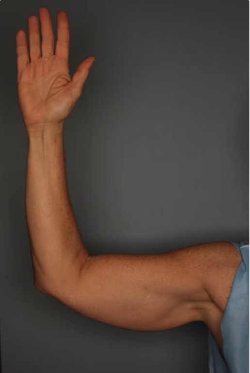 CoolSculpting® Before, Female 48 - 4040