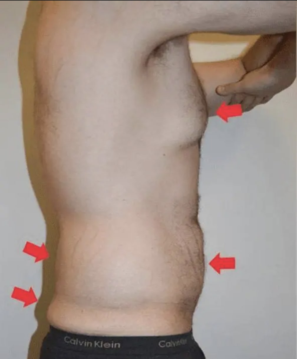 Liposuction Before, Male 37 - 4113