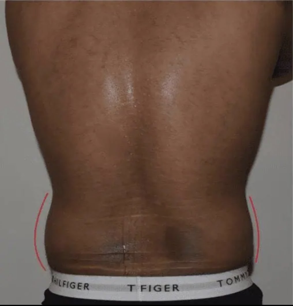 Liposuction Before, Male 40 - 4115