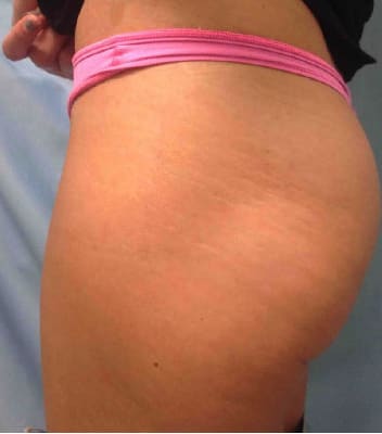 Skin Smoothing Solutions Before, Female 31 - 4142