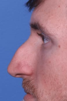 Rhinoplasty Before, Male 28 - 4156