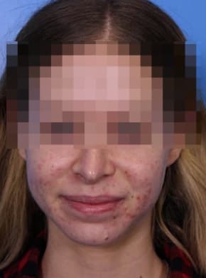 Acne Treatment Before, Female 22 - 4139