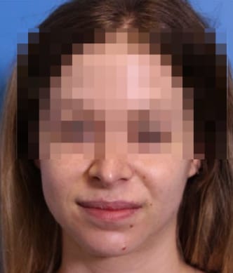 Acne Treatment After, Female 22 - 4139