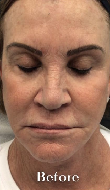 Dermal Fillers & Injectables Before, Female 60 - 4241