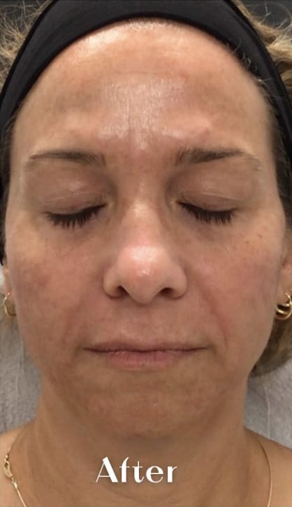 Dermal Fillers & Injectables After, Female 41 - 4242