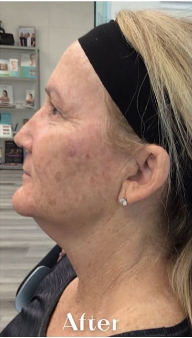 Neck & Jawline Definition Solutions After, Female 63 - 4244