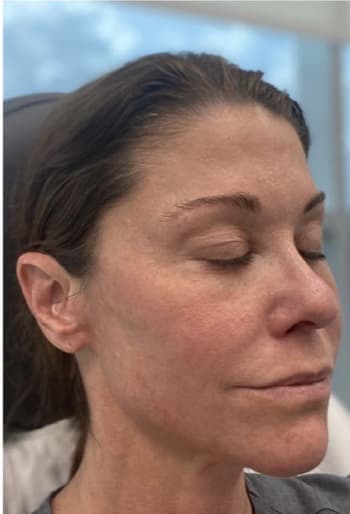 Botox After, Female 54 - 4248