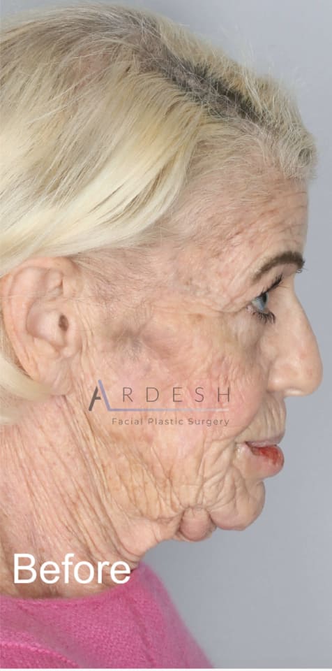 Facelift Before, Female 70 - 4253