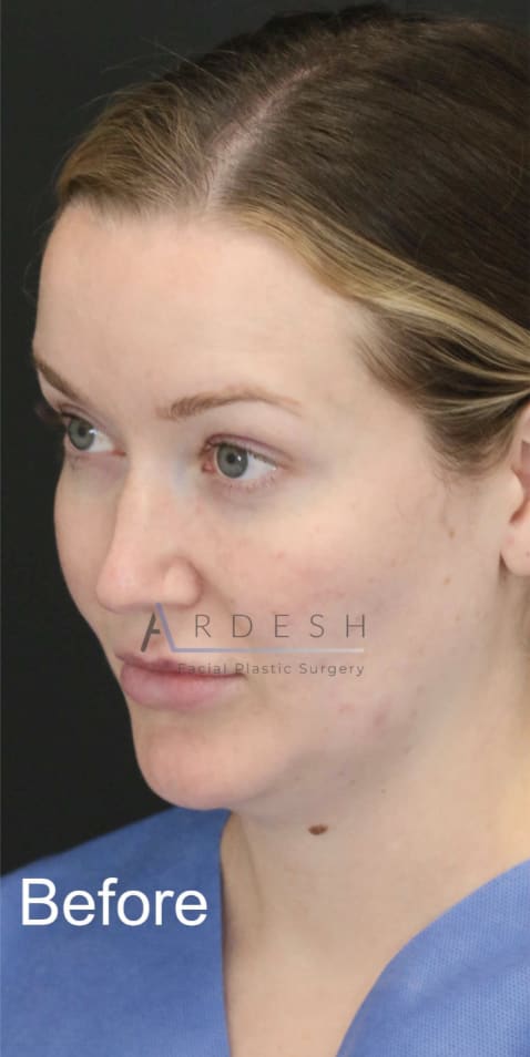 Facelift Before, Female 37 - 4259