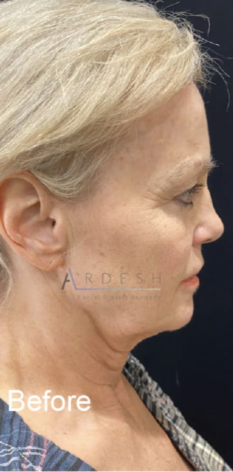 Facelift Before, Female 60 - 4260