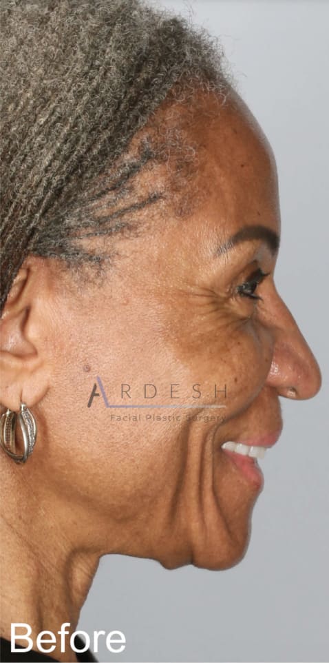 Facelift Before, Female 58 - 4262