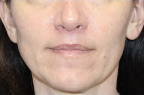 Buccal Fat Removal After, Female 47 - 4327