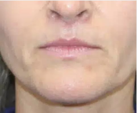 Lip Lift After, Female 45 - 4328