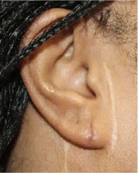 Earlobe Surgery After, Male 27 - 4329