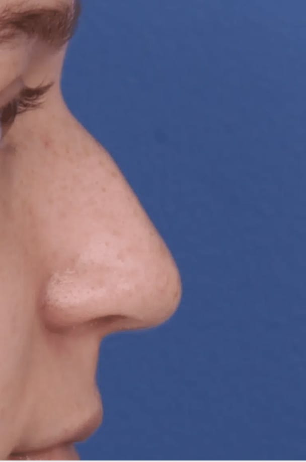 Rhinoplasty Before, Female 29 - 4339