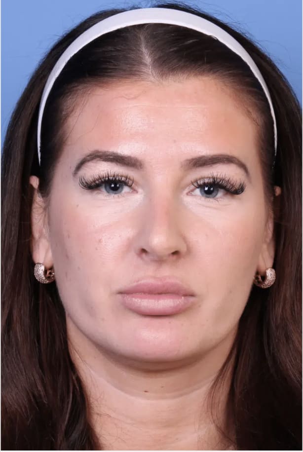 Rhinoplasty After, Female 30 - 4340