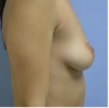 Breast Augmentation (Augmentation Mammaplasty) Before, Female 29 - 4347