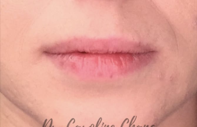 Dermal Fillers & Injectables Before, Male 39 - 4362