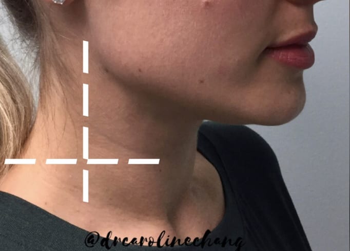 PDO Thread Lift Before, Female 36 - 4365