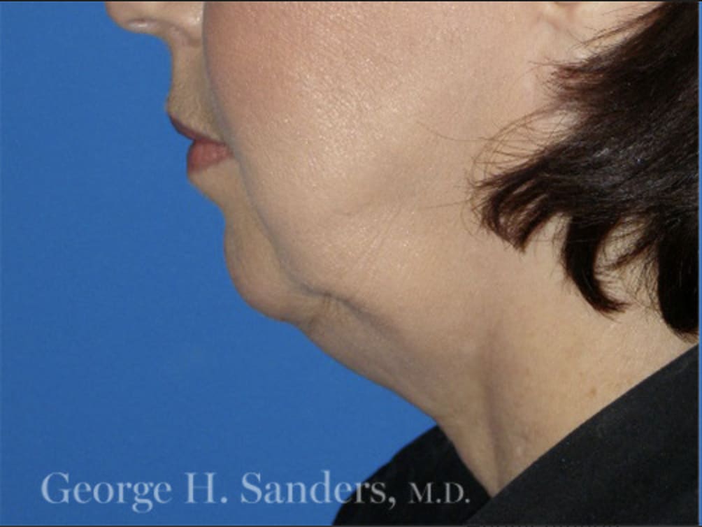 Chin Augmentation Before, Female 62 - 4383