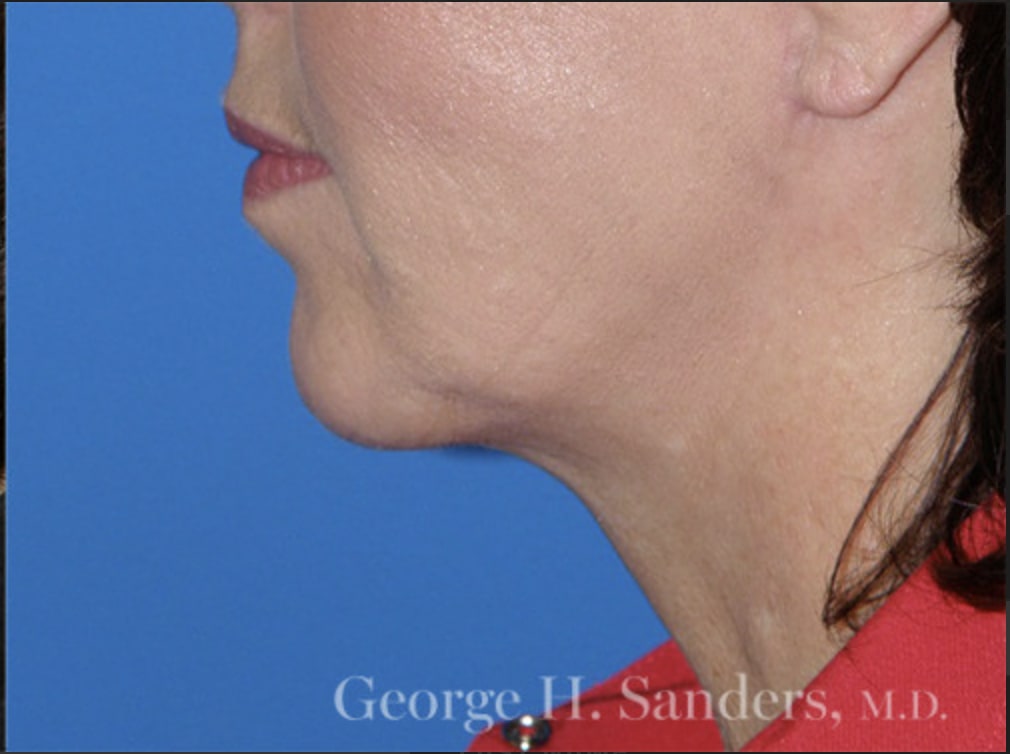 Chin Augmentation After, Female 62 - 4383