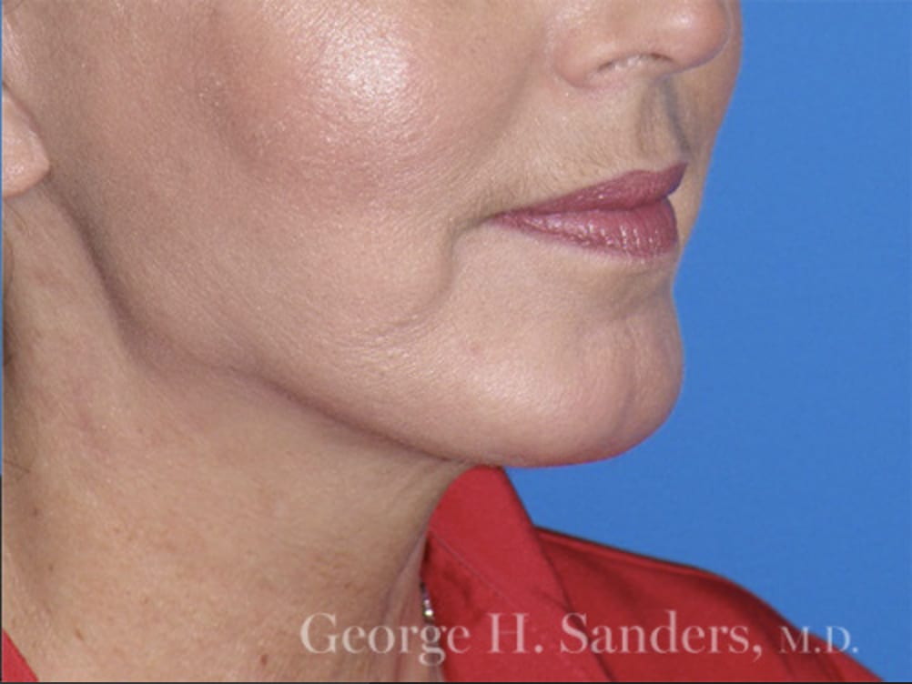 Chin Augmentation After, Female 61 - 4384