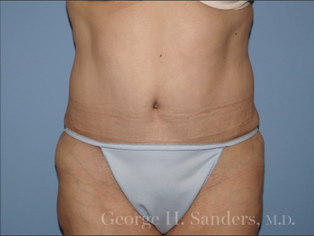 Tummy Tuck (Abdominoplasty) After, Female 68 - 4388