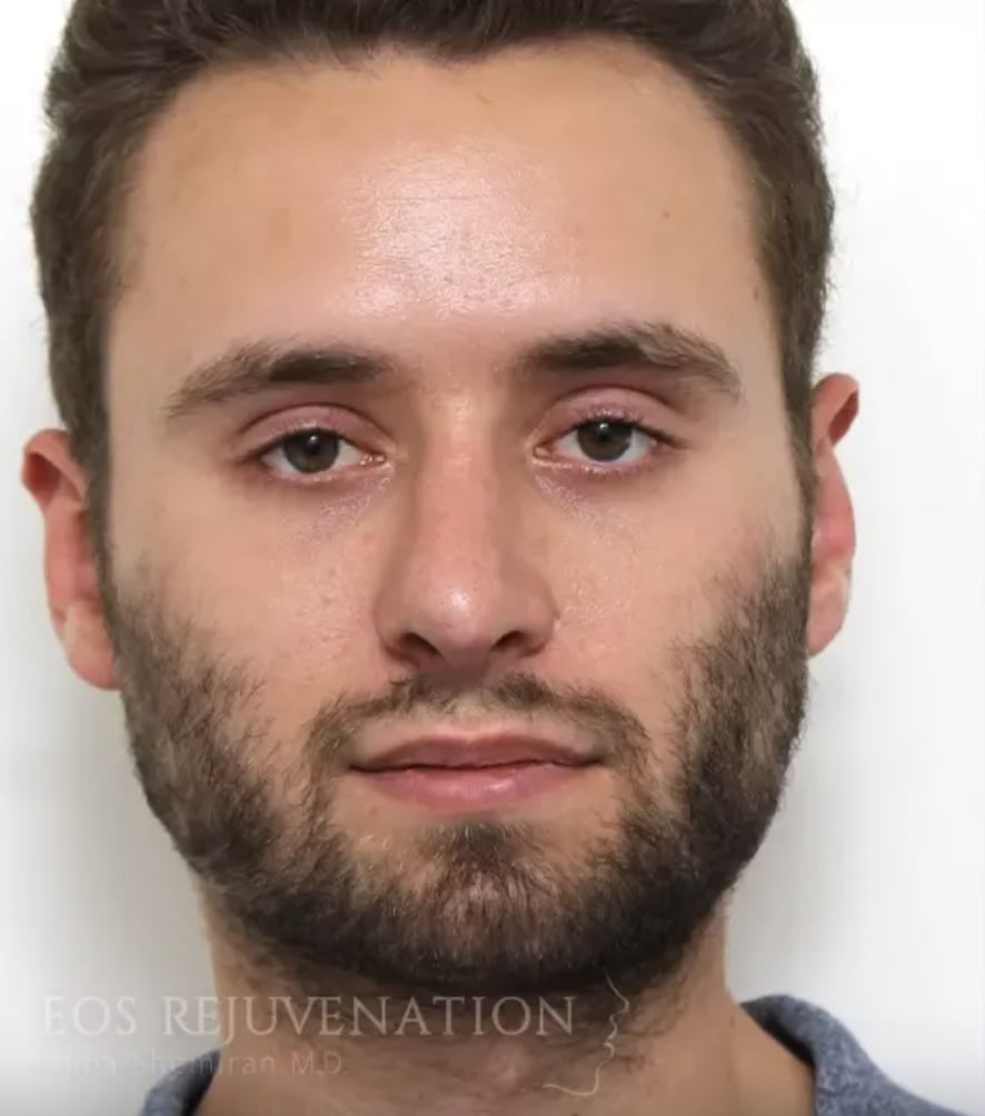 Otoplasty Before, Male 34 - 4413