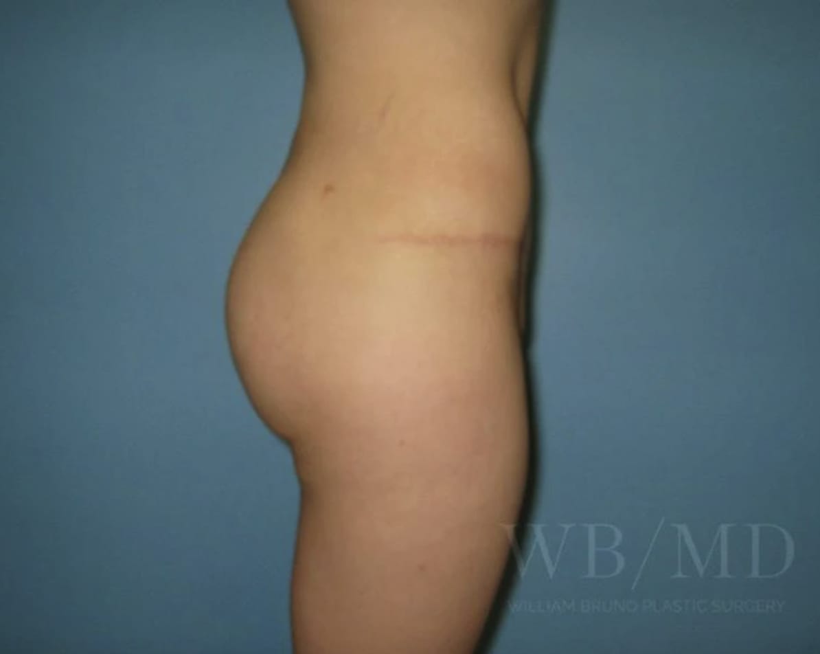 Brazilian Butt Lift After, Female 25 - 4441