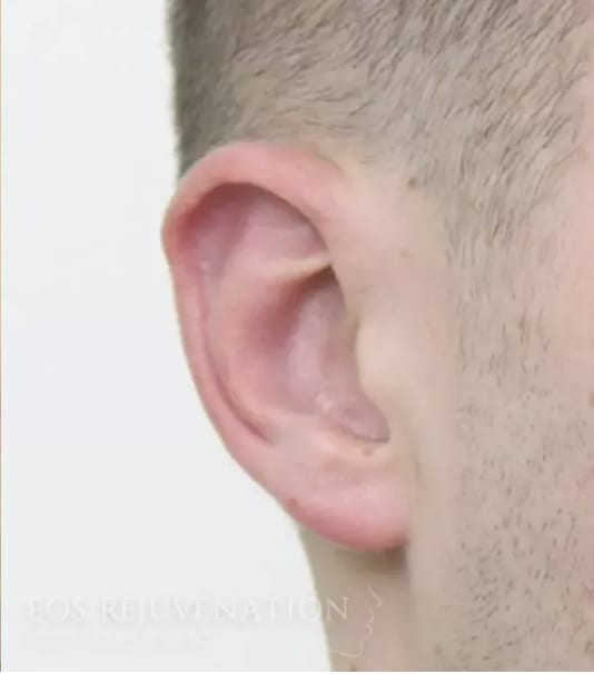 Otoplasty After, Male 34 - 4414