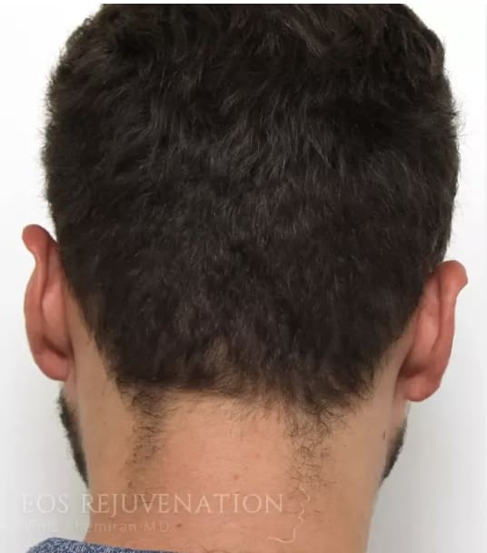 Otoplasty Before, Male 34 - 4415