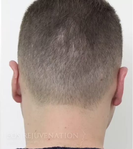 Otoplasty After, Male 34 - 4415