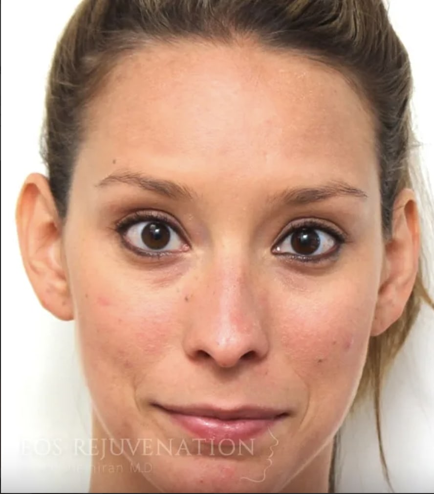 Otoplasty Before, Female 31 - 4416