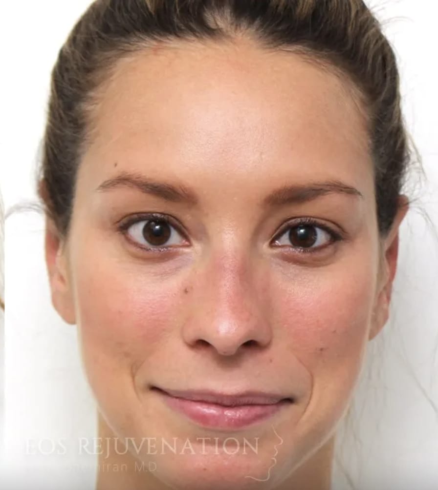 Otoplasty After, Female 31 - 4416