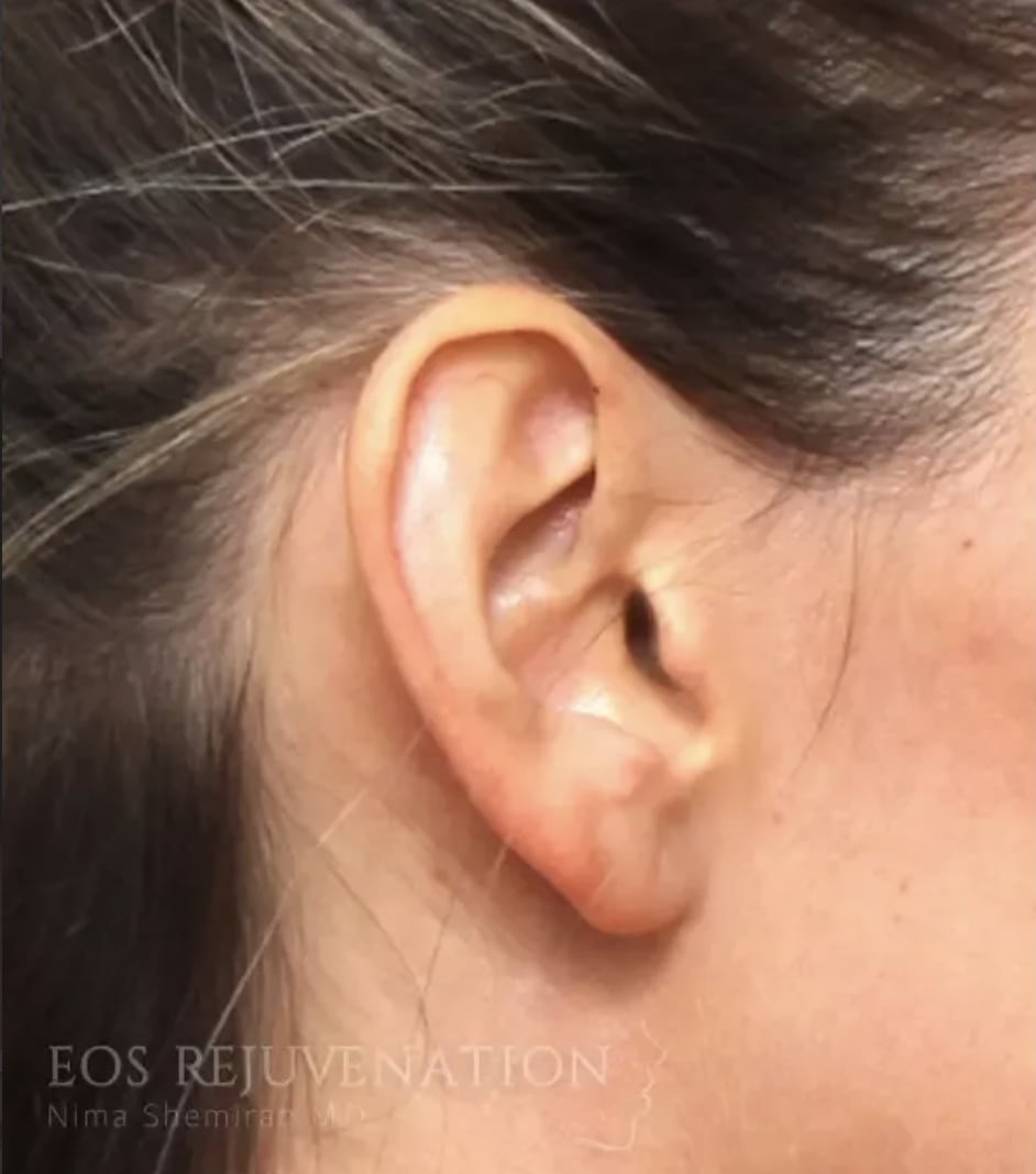 Otoplasty Before, Female 31 - 4418