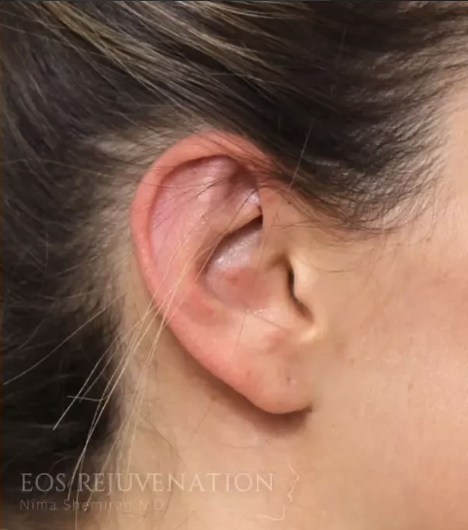 Otoplasty After, Female 31 - 4418