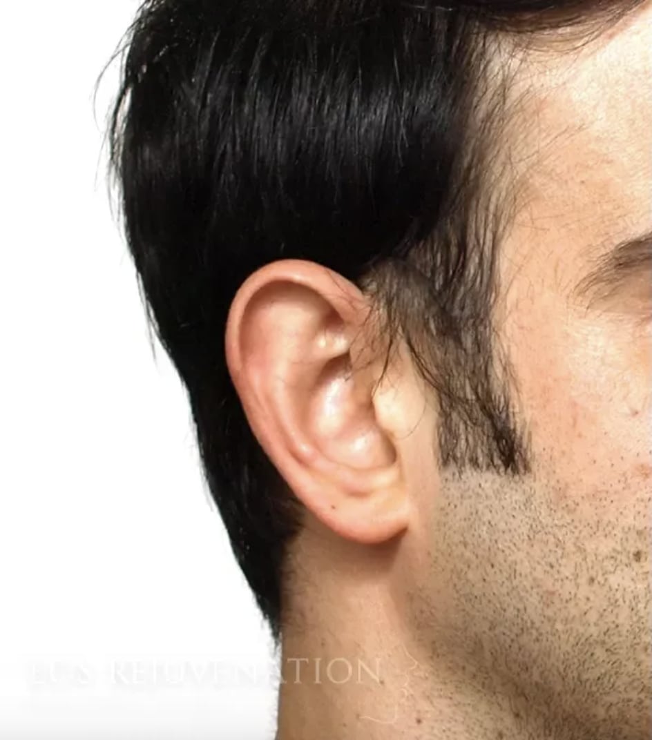 Otoplasty Before, Male 30 - 4420