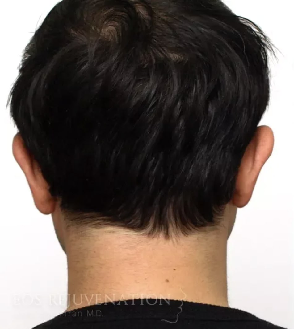 Otoplasty Before, Male 30 - 4421