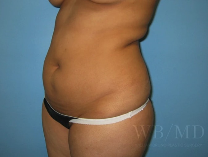 Liposuction Before, Female 24 - 4444