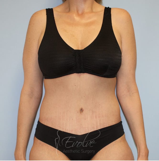 Tummy Tuck (Abdominoplasty) After, Female 42 - 4478