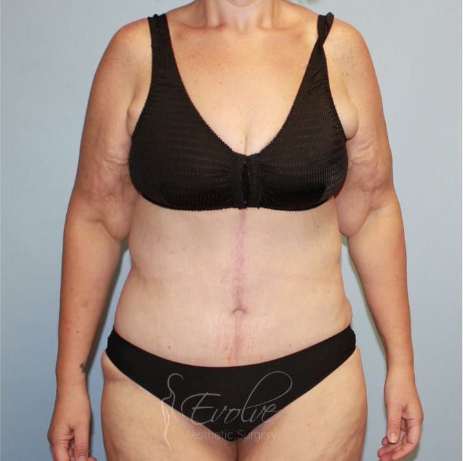Tummy Tuck (Abdominoplasty) After, Female 59 - 4484