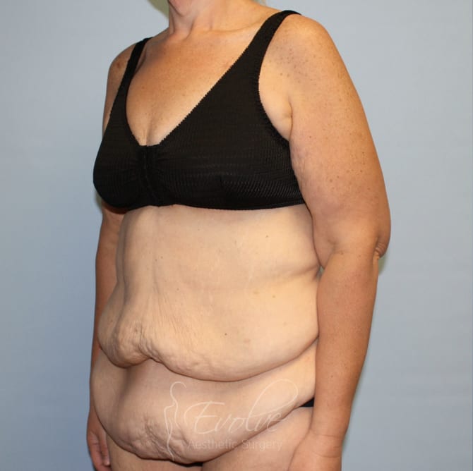 Tummy Tuck (Abdominoplasty) Before, Female 59 - 4485