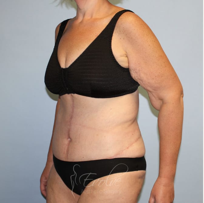 Tummy Tuck (Abdominoplasty) After, Female 59 - 4485