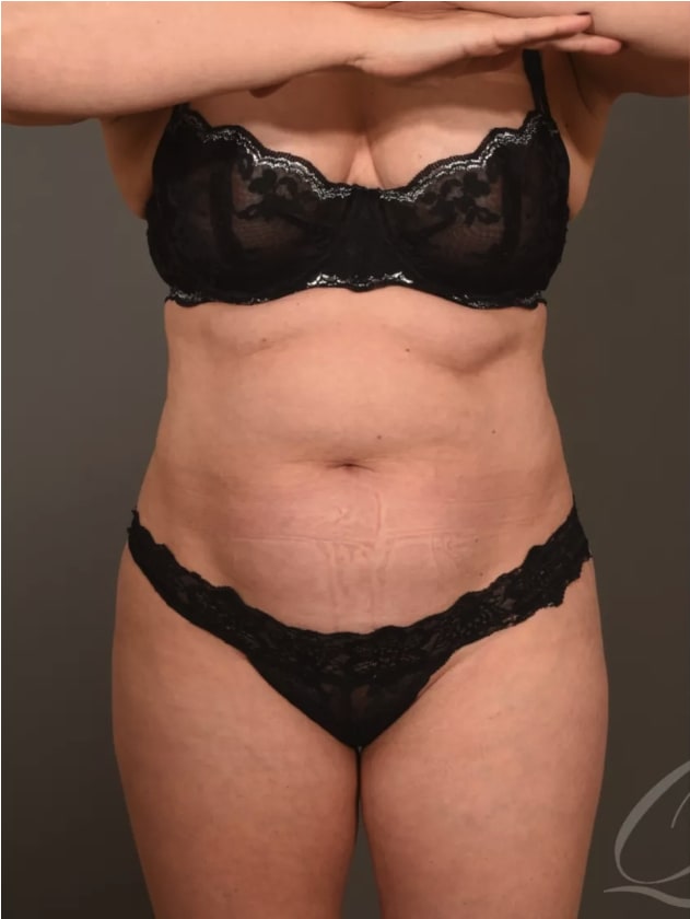 Liposuction Before, Female 41 - 4546