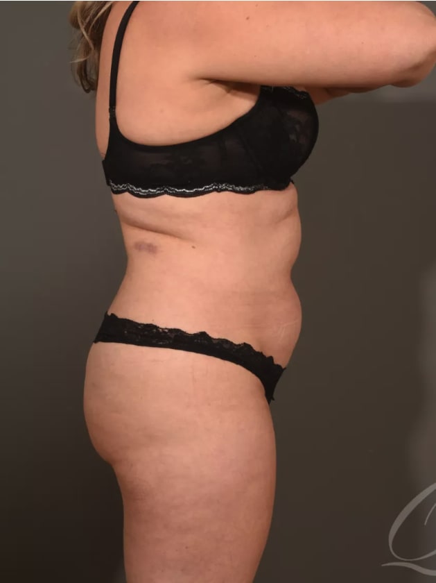 Liposuction Before, Female 41 - 4548