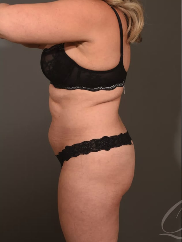 Liposuction Before, Female 41 - 4550