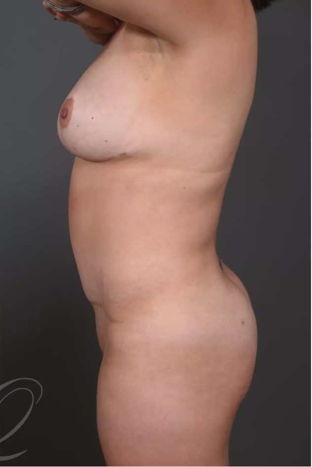 Tummy Tuck (Abdominoplasty) After, Female 40 - 4545