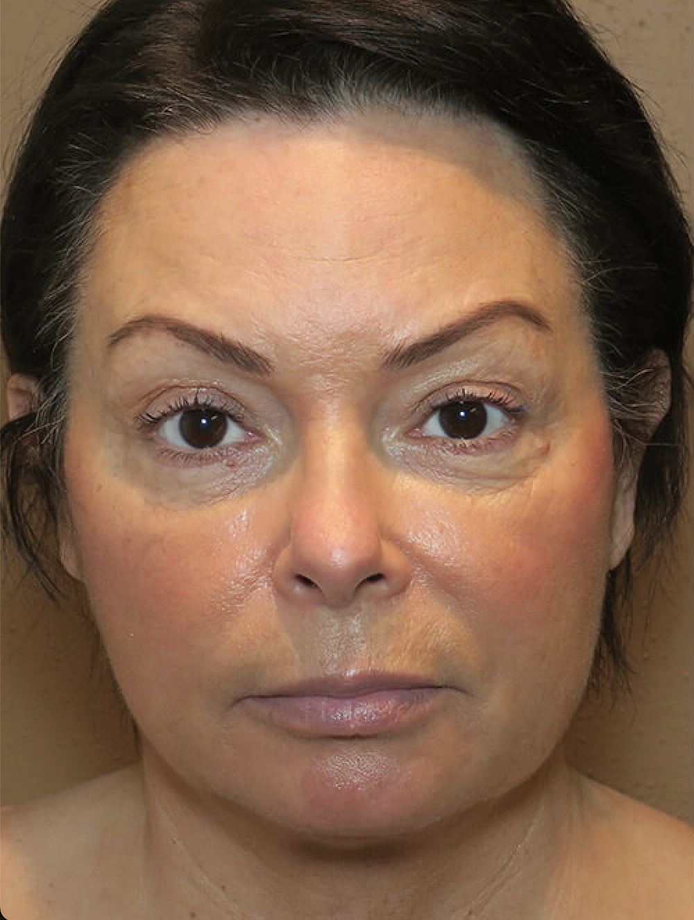 Buccal Fat Removal Before, Female 46 - 4561