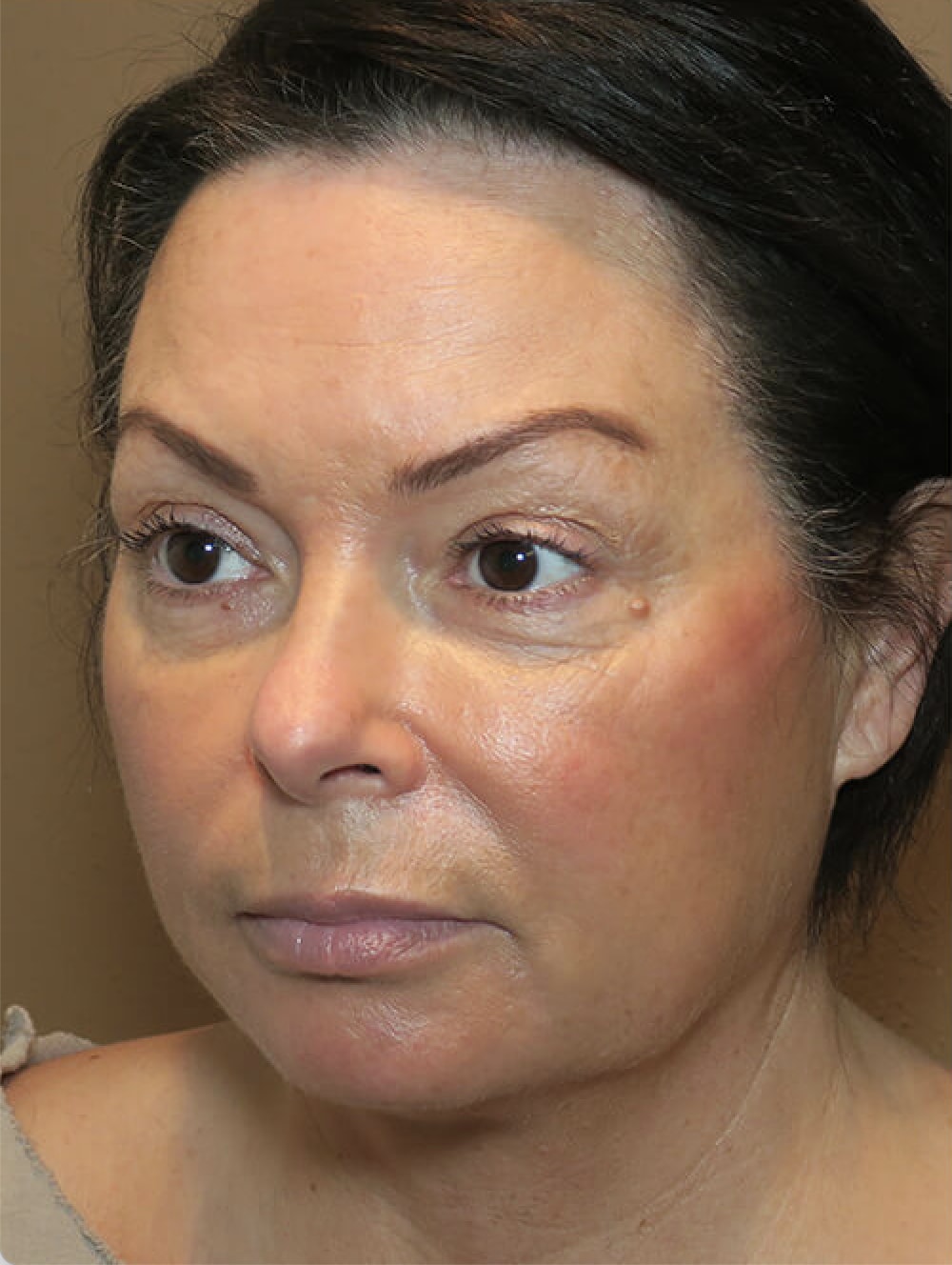 Buccal Fat Removal Before, Female 46 - 4562